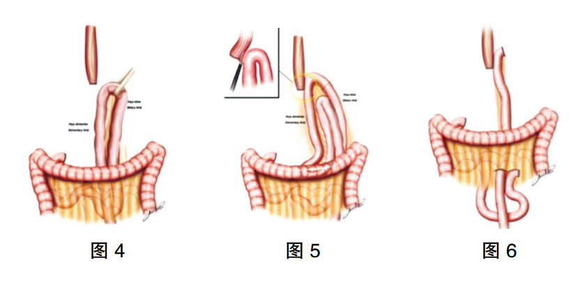 胃毕二式手术方式图片图片