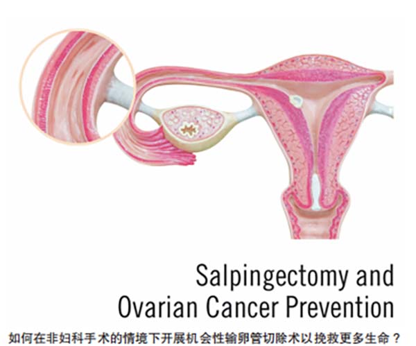 输卵管切除术的卵巢癌预防作用