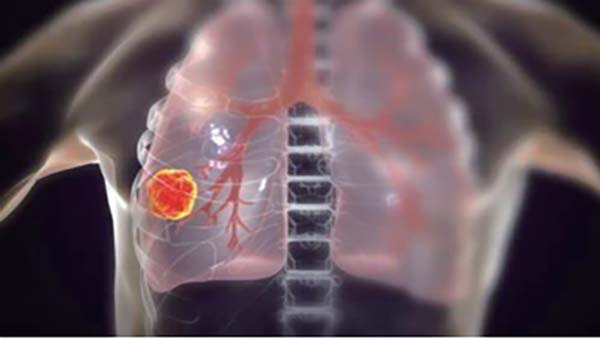 可切除的ⅢA~ⅢB期NSCLC 联用纳武利尤单抗对比单纯新辅助化疗更佳