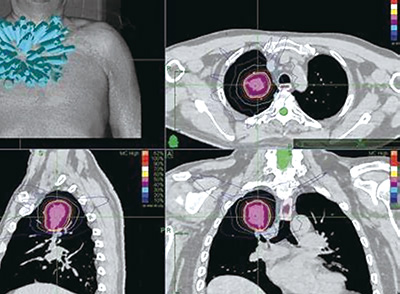 不可切除的局部晚期NSCLC 原发灶SBRT后同步化放疗和巩固治疗或可被接受