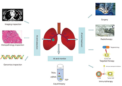 ICI治疗NSCLC 人工智能模型有望独立预测生存