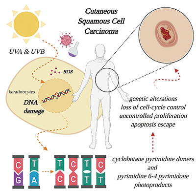紫外线辐射相关症状与皮肤鳞状细胞癌相关