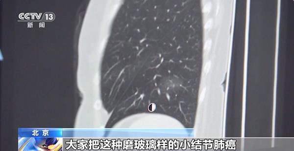 连续10年全球死亡率第一！这种癌症早期通常无症状，专家提醒→
