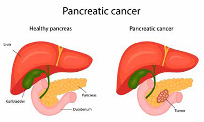 389-390期《全球肿瘤快讯》-45-.jpg 389-390期《全球肿瘤快讯》-45-.jpg