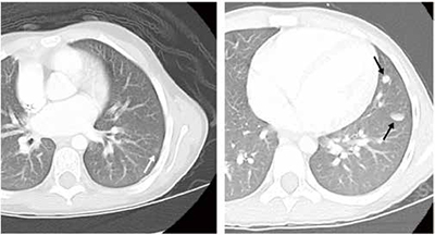 389-390期《全球肿瘤快讯》-70-.jpg 389-390期《全球肿瘤快讯》-70-.jpg