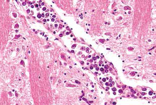 血管内大B细胞淋巴瘤的诊断特征分析