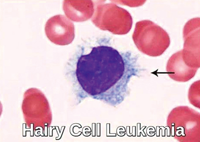 毛细胞白血病预后好但第二恶性肿瘤风险高