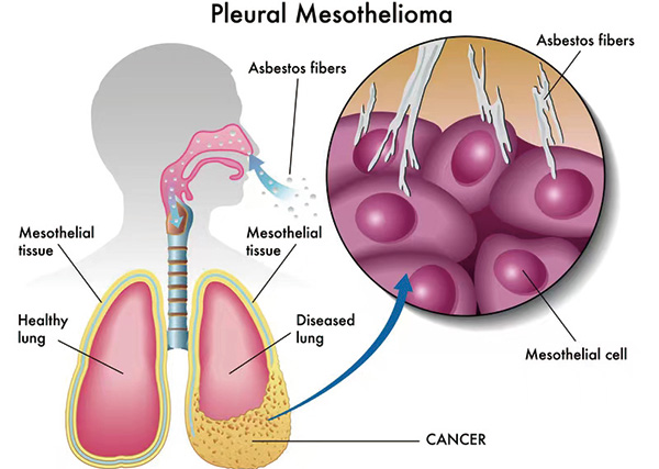 间皮素阳性晚期恶性胸膜间皮瘤 二线应用Anetumab ravtansine不优于长春瑞滨