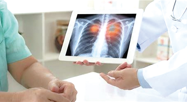 RET融合阳性NSCLC 早使用Selpercatinib或有预防CNS转移作用