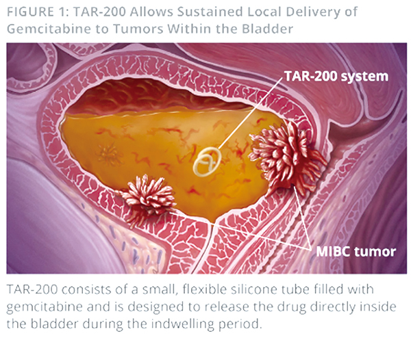 BCG难治性非肌层浸润性膀胱癌 TAR-200局部持续释放吉西他滨完全缓解率高