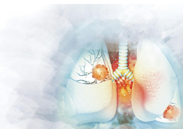 METex14跳跃突变的NSCLC Tepotinib初治或复治时的疗效稳健而持久