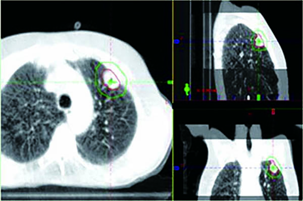 治疗小细胞肺癌的脑转移时 立体定向放射外科手术的认知损害更低 