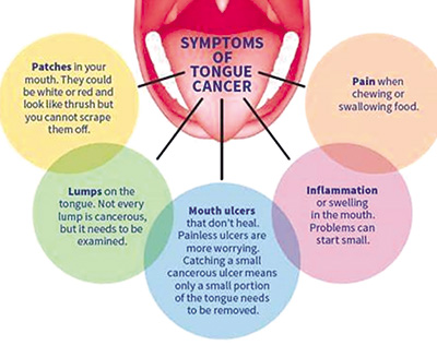 炎症性舌病与舌癌风险激增显著相关