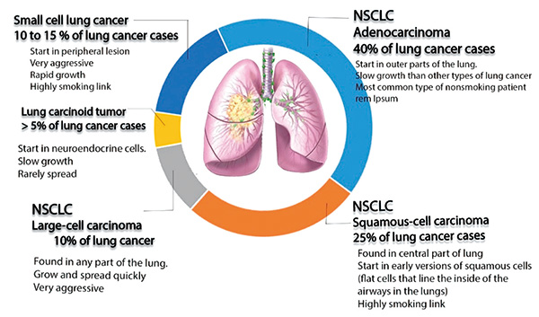 晚期鳞状NSCLC 派安普利单抗联合化疗或为新的一线方案