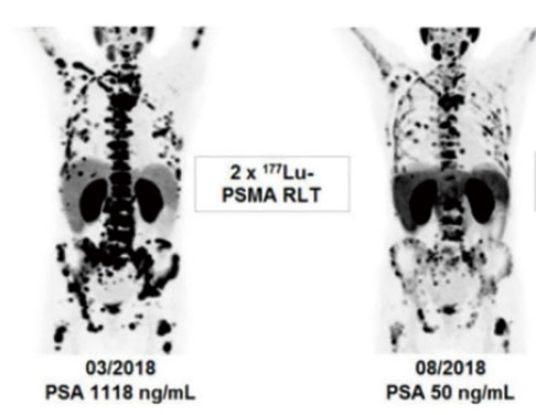 多线治疗失败的mCRPC 或可选用225Ac-PSMA RLT 