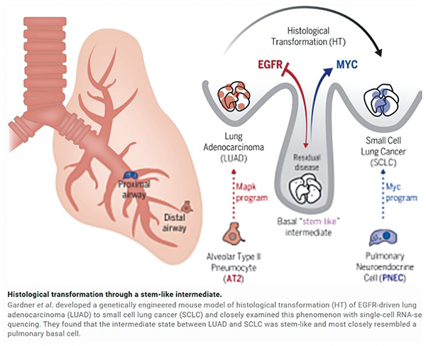 研究揭示肺腺癌向小细胞肺癌转化机制