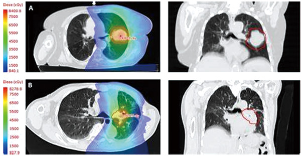 合并间质性肺病的早期NSCLC 权衡风险和获益后可使用SABR