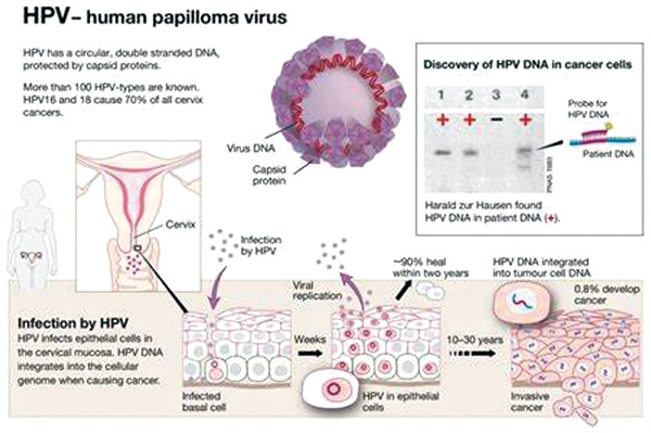 HPV ctDNA或不能指导口咽癌的辅助治疗 