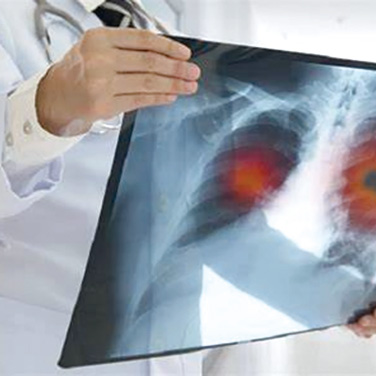 一线免疫治疗转移性NSCLC 缓解率和PFS仅与OS中度相关