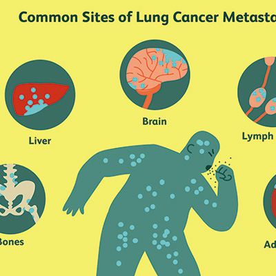 HER2过表达、不可切除/转移性NSCLC T-DXd初显抗肿瘤活性