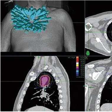 中央型局限性不可切除早期NSCLC SBRT与可接受的局部控制率相关