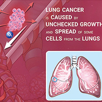 局部晚期NSCLC 同步化放疗时采用IMRT有更好的长期疗效