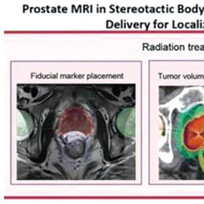 治疗前列腺癌 MRI引导SBRT显示优于CT引导的优势