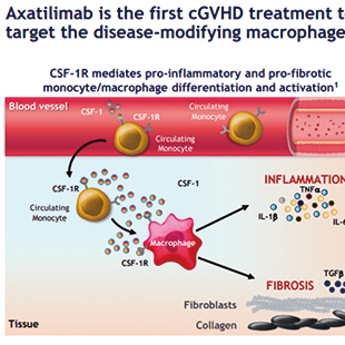 复发或难治性慢性GVHD axatilimab治疗可带来较高的缓解率