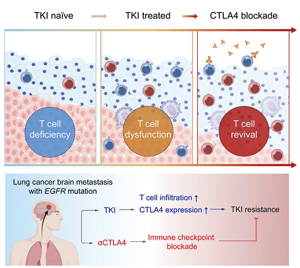 研究发现CTLA4阻断治疗肺癌脑转移中TKI耐药