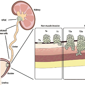 纳武利尤单抗尿路上皮癌一线治疗适应证获批
