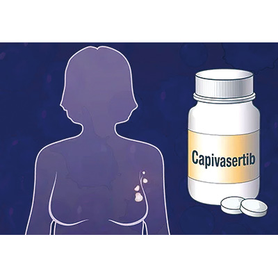 转移性三阴性乳腺癌 卡匹色替联合紫杉醇方案疗效研究