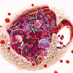 CNS继发的大B细胞淋巴瘤 新发者、CNS孤立性复发者结局较好，CNS/全身同步复发者最差