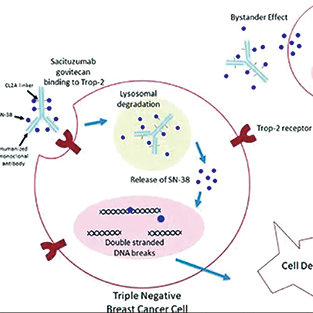 晚期三阴性乳腺癌​ 戈沙妥珠单抗联合帕博利珠单抗显著延长无进展生存