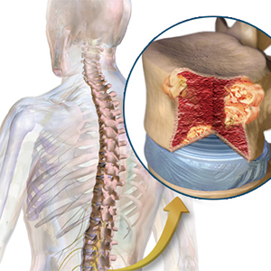对比女性，男性的MM高发且肿瘤负担更大