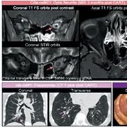 CAR T免疫毒性或增加骨髓瘤非复发死亡风险