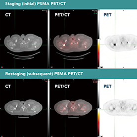 中危前列腺癌 术前影像学分期对淋巴结浸润检出价值有限