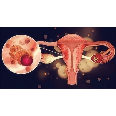 经治HER2阳性晚期或复发子宫内膜癌 三代HER2靶向抗体偶联药Trastuzumab pamirtecan有活性